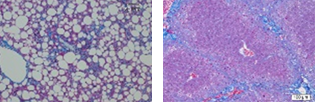 Hepatitis