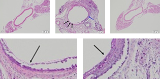 Abdominal aortic aneurysm