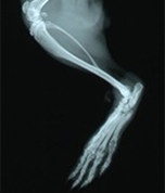 Rheumatoid arthritis (RA)